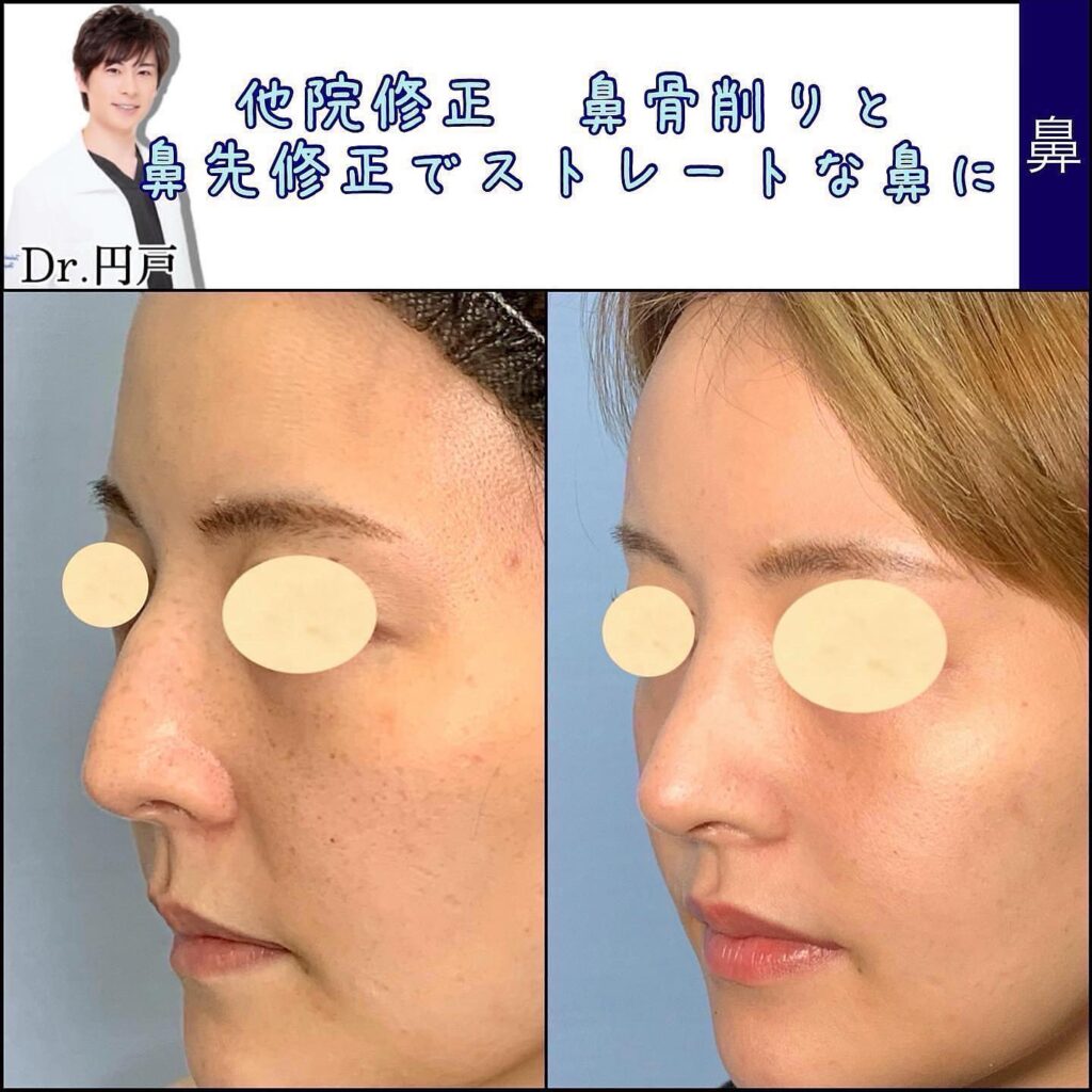 鷲鼻と鼻先の下垂を治して滑らかなストレートな鼻にした修正手術の斜めから見た6ヶ月後の症例