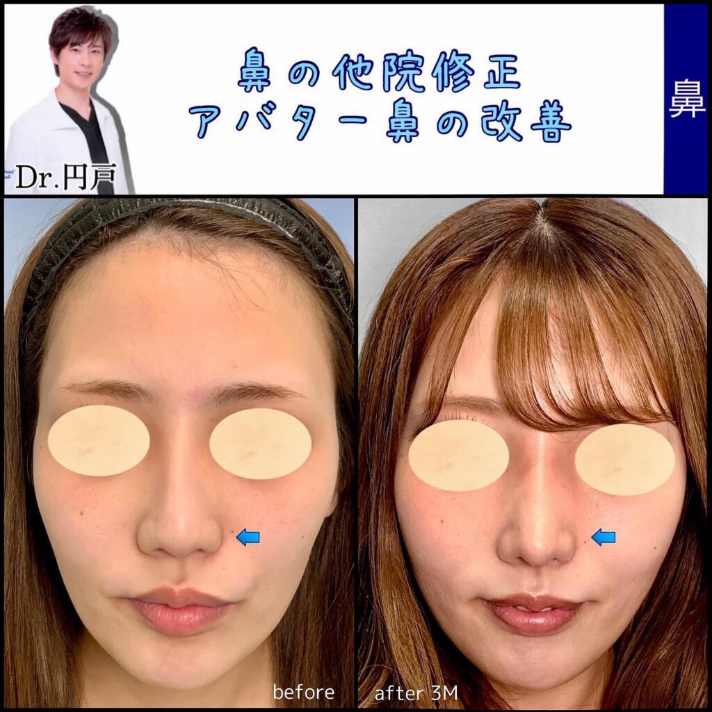 正面から見たアバター鼻の他院修正の症例写真