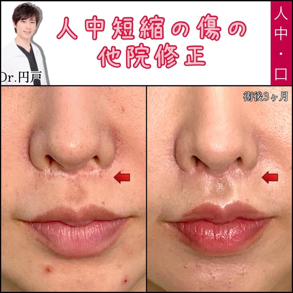人中短縮手術の傷跡の他院修正
