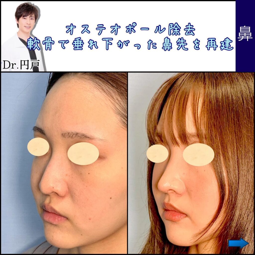 オステオポールを除去した鼻の修正の症例