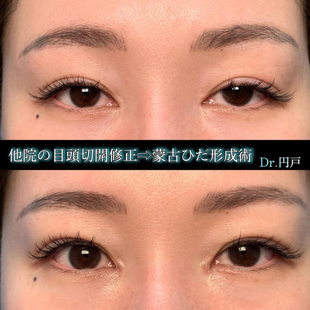 目頭切開の他院修正の症例
