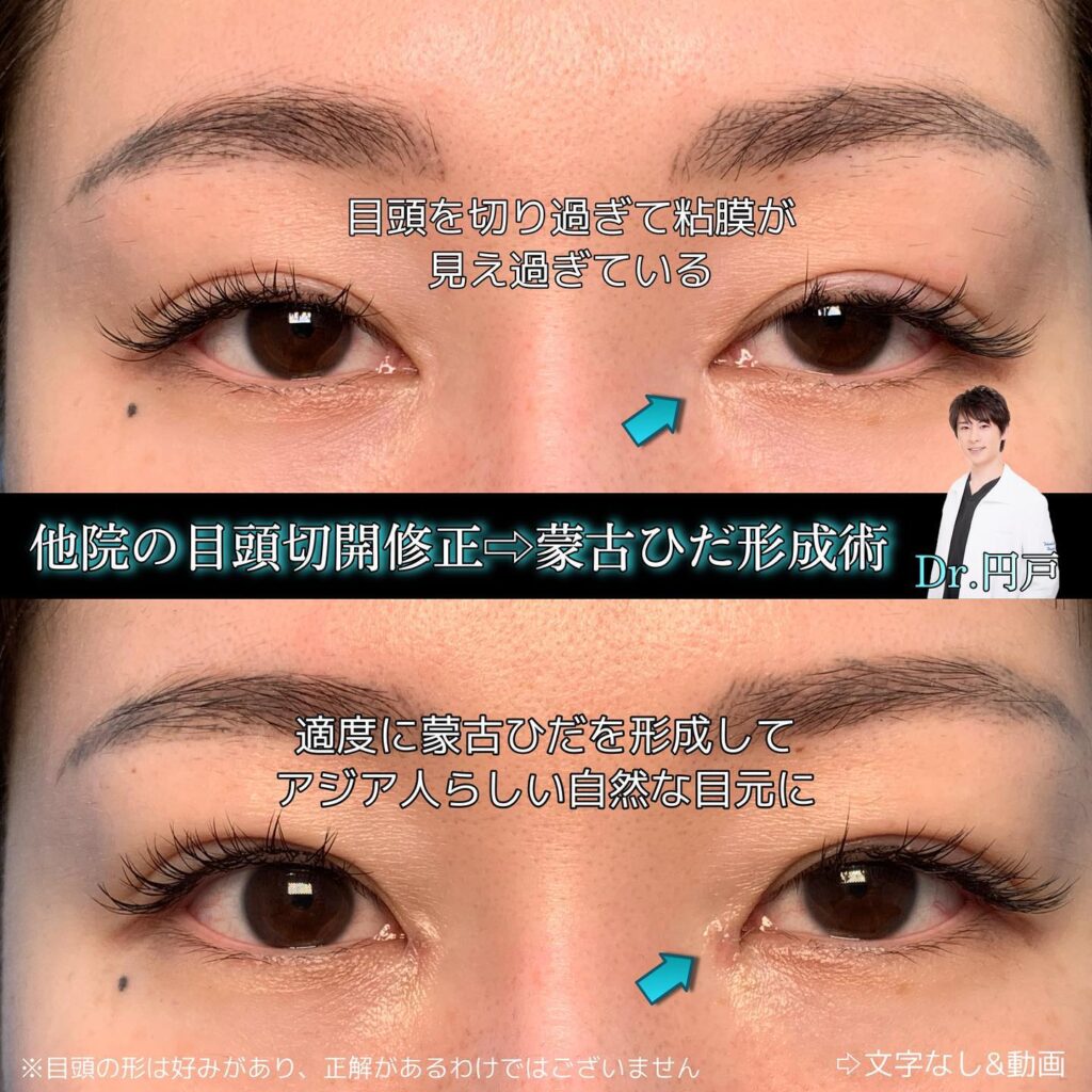 目頭切開の他院修正の症例の図解