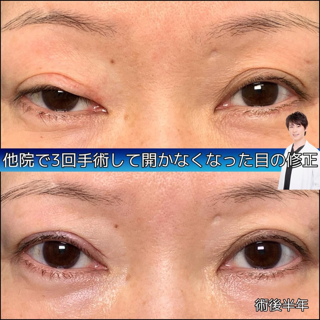 他院で3回手術をいて目が開かなくなった他院修正