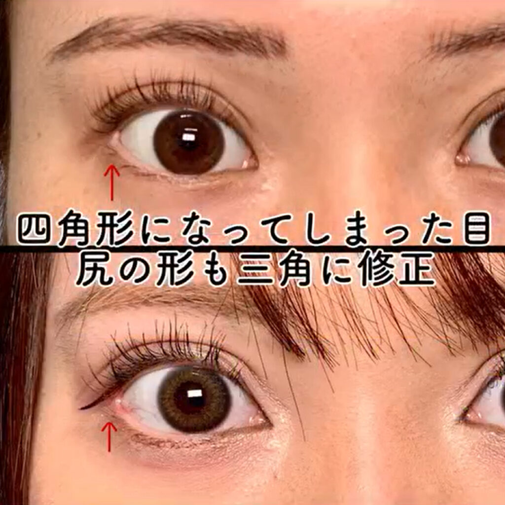 四角形になってしまった目尻の他院修正