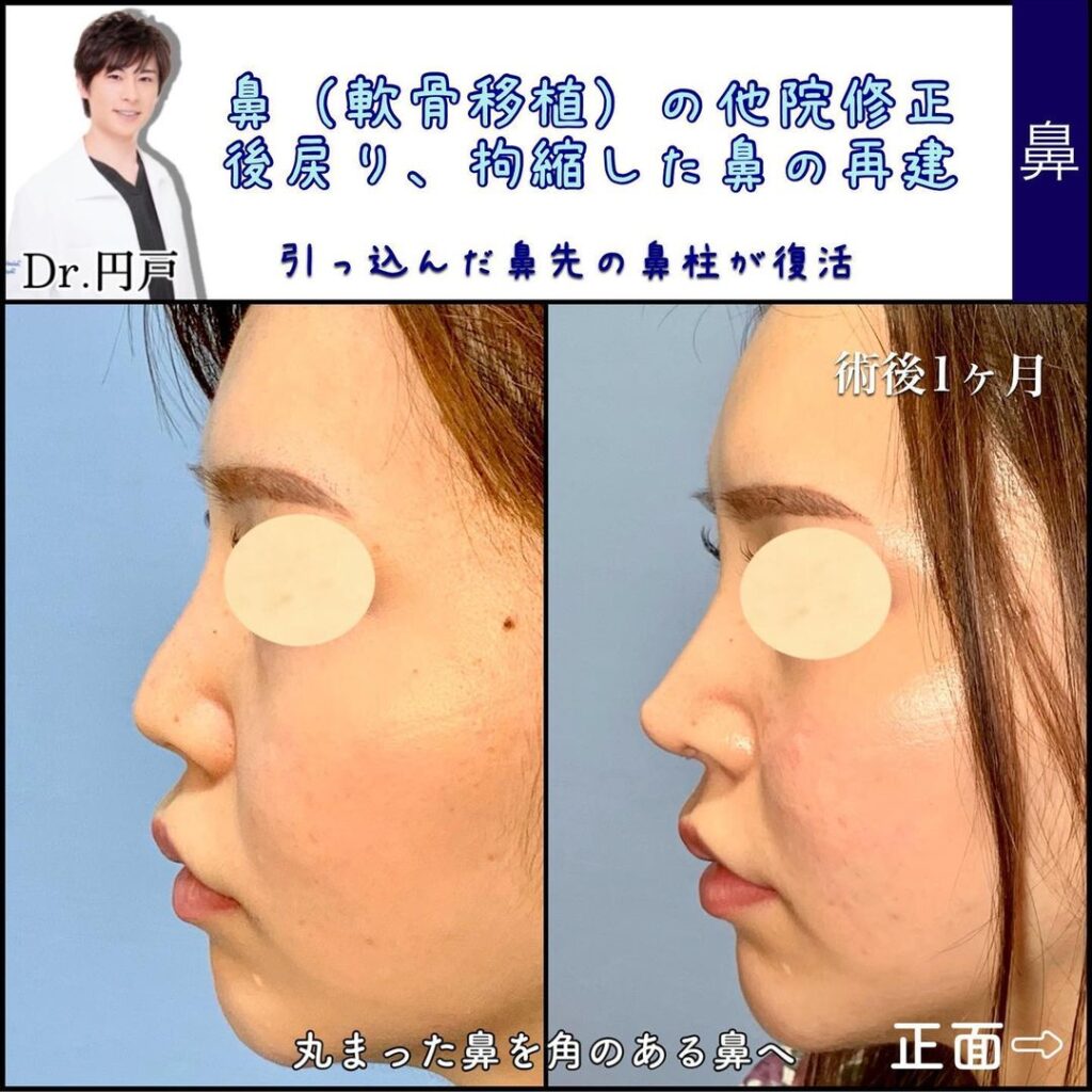 整形後に戻りしてしまった鼻の修正手術の横から見た1か月後の症例