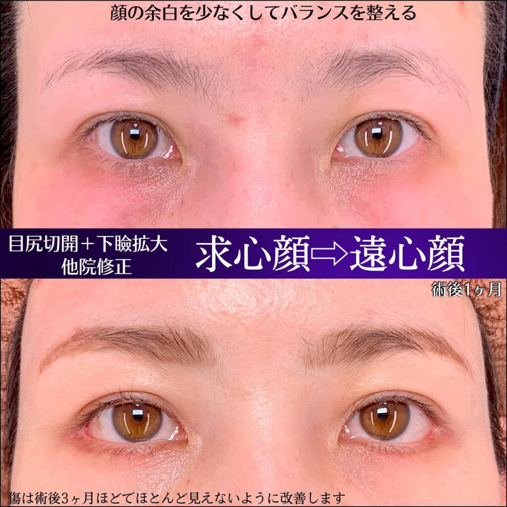 目尻切開とタレ目形成の他院修正の症例