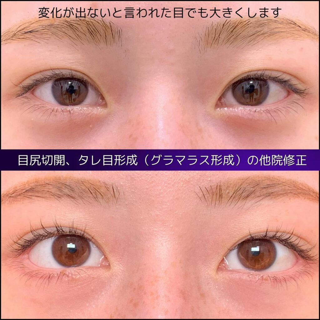 目尻切開とタレ目形成の他院修正の手術後1ヶ月後の両目