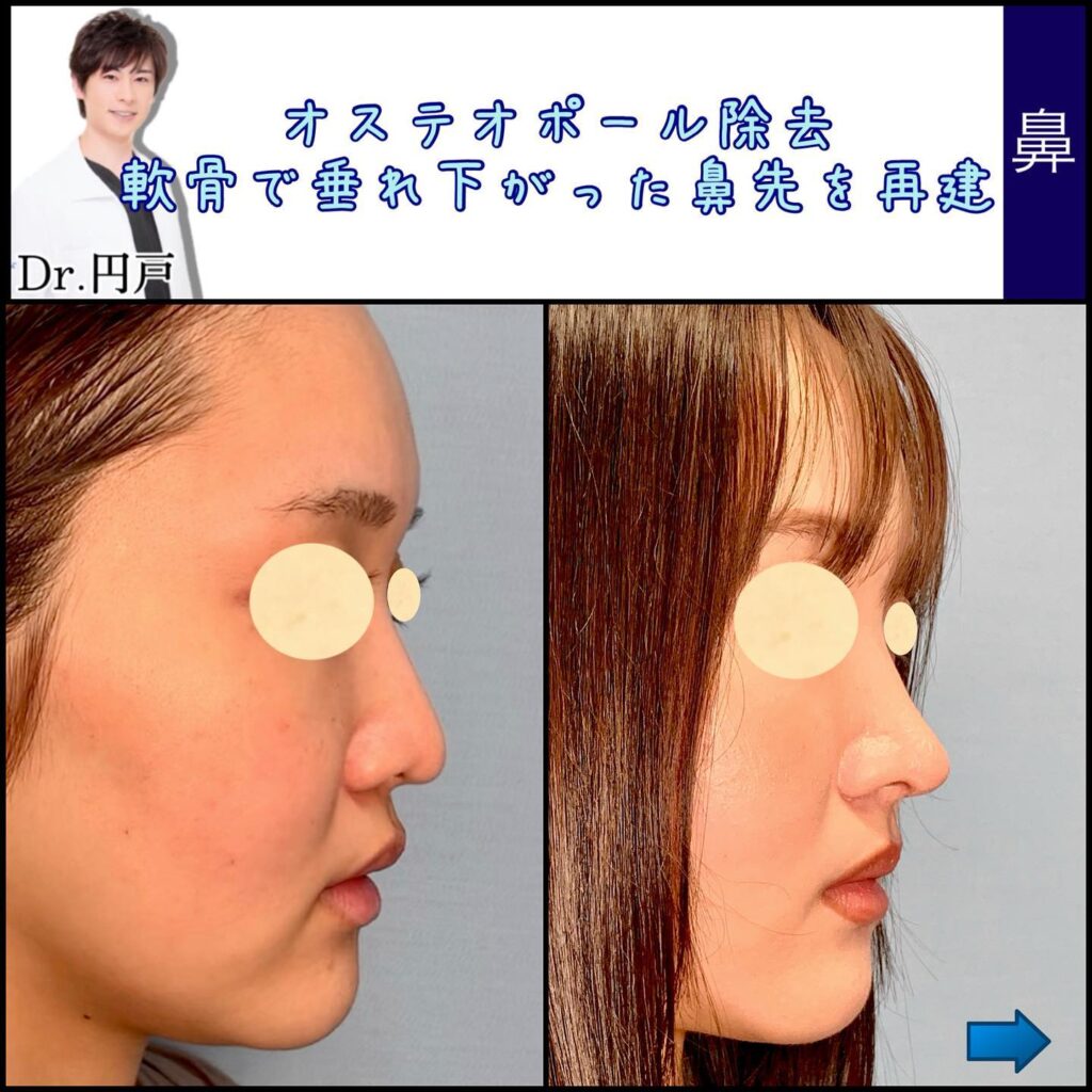 オステオポールを除去した鼻の修正の横から見た症例