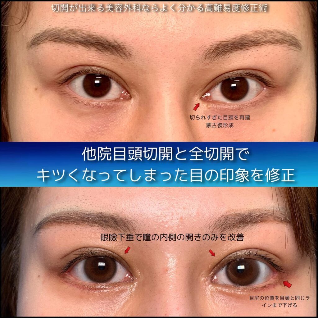 きつい目を改善した他院修正