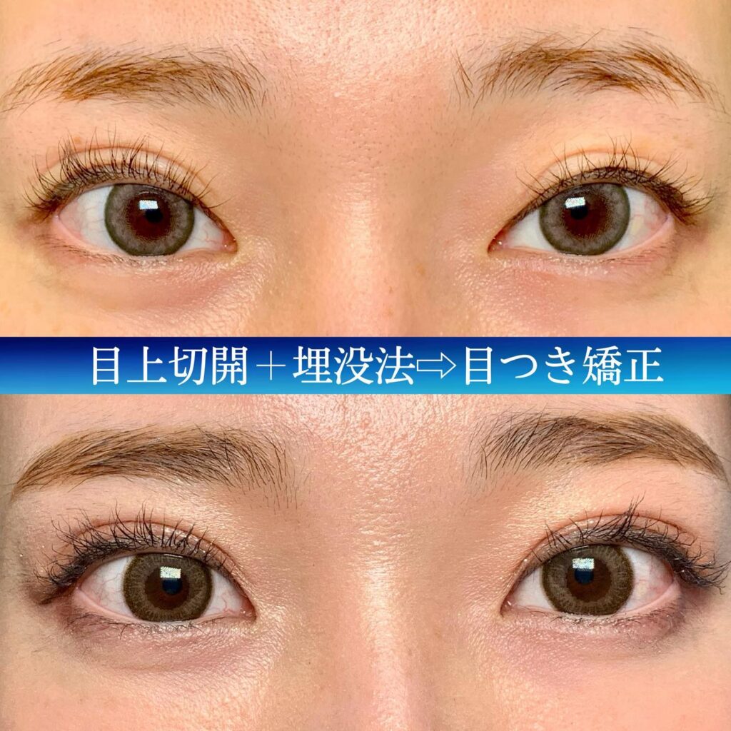 食い込みが弱い全切開の他院修正