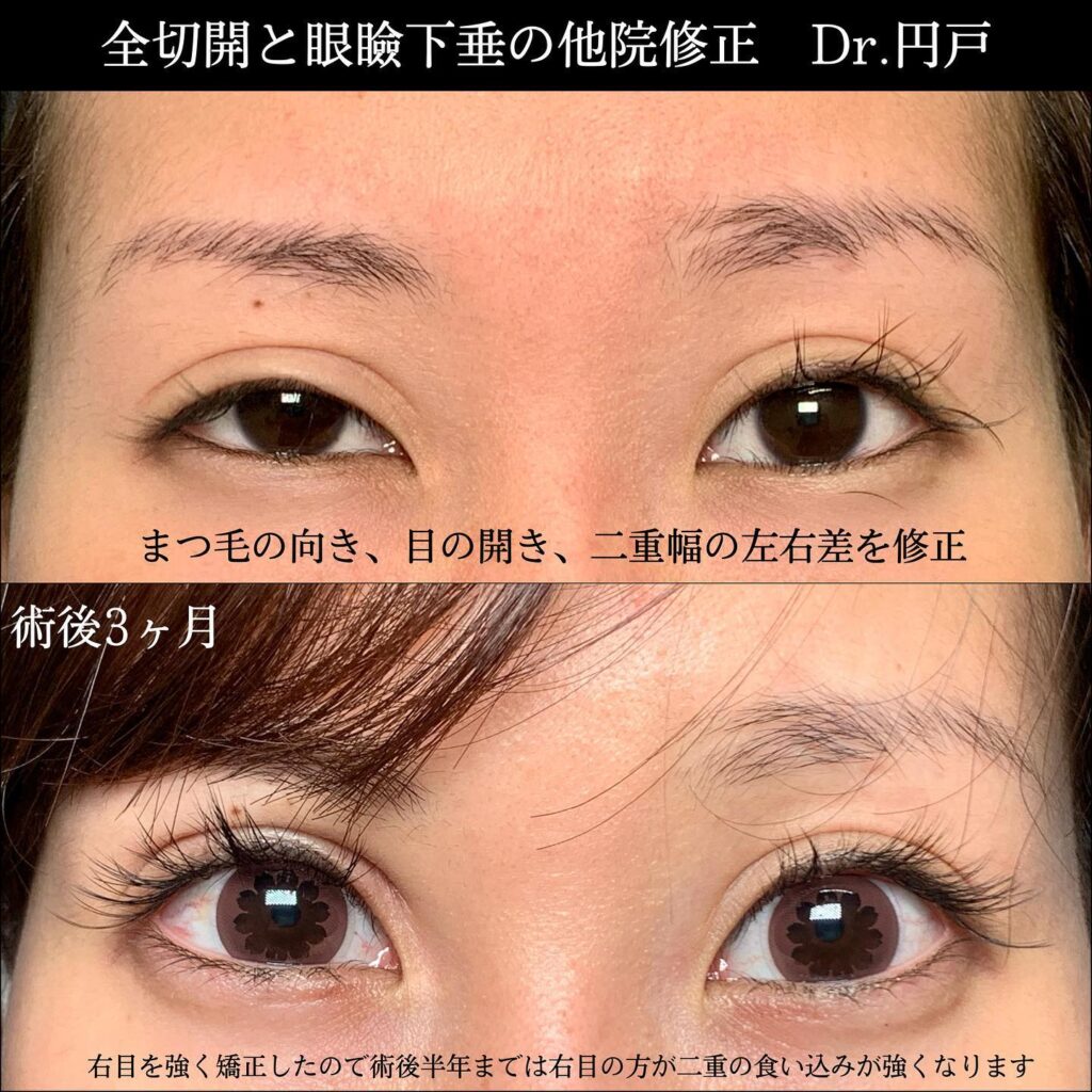 全切開と眼瞼下垂の他院修正の3か月後の症例
