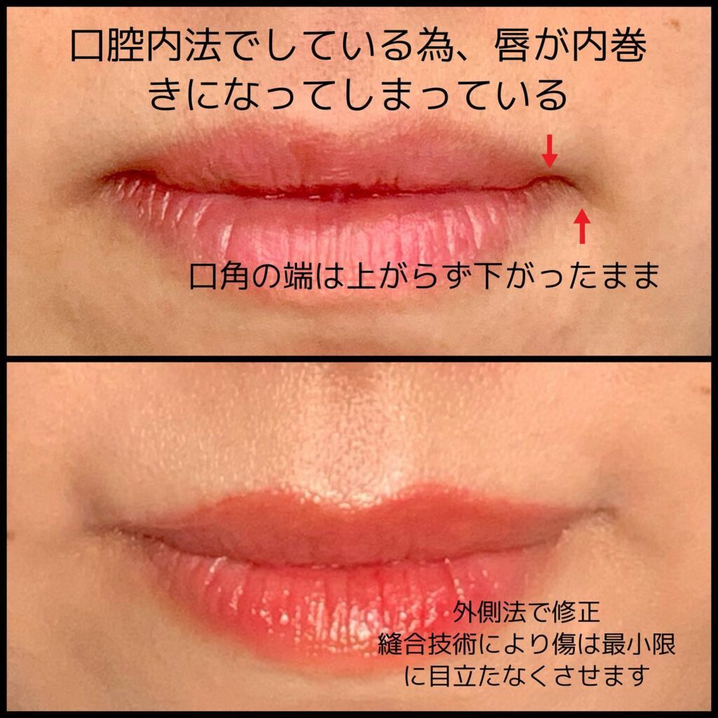 口角挙上の他院修正の症例の図解