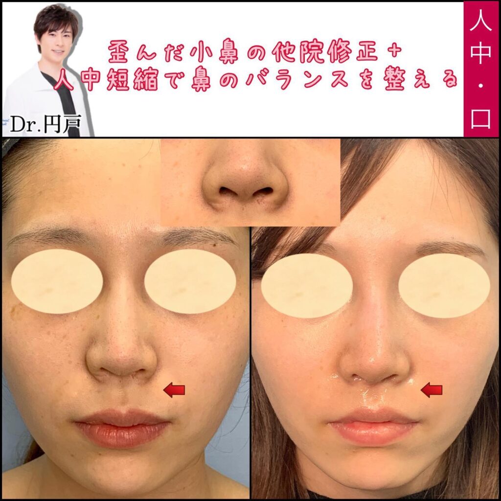 歪んだ小鼻の他院修正の図解