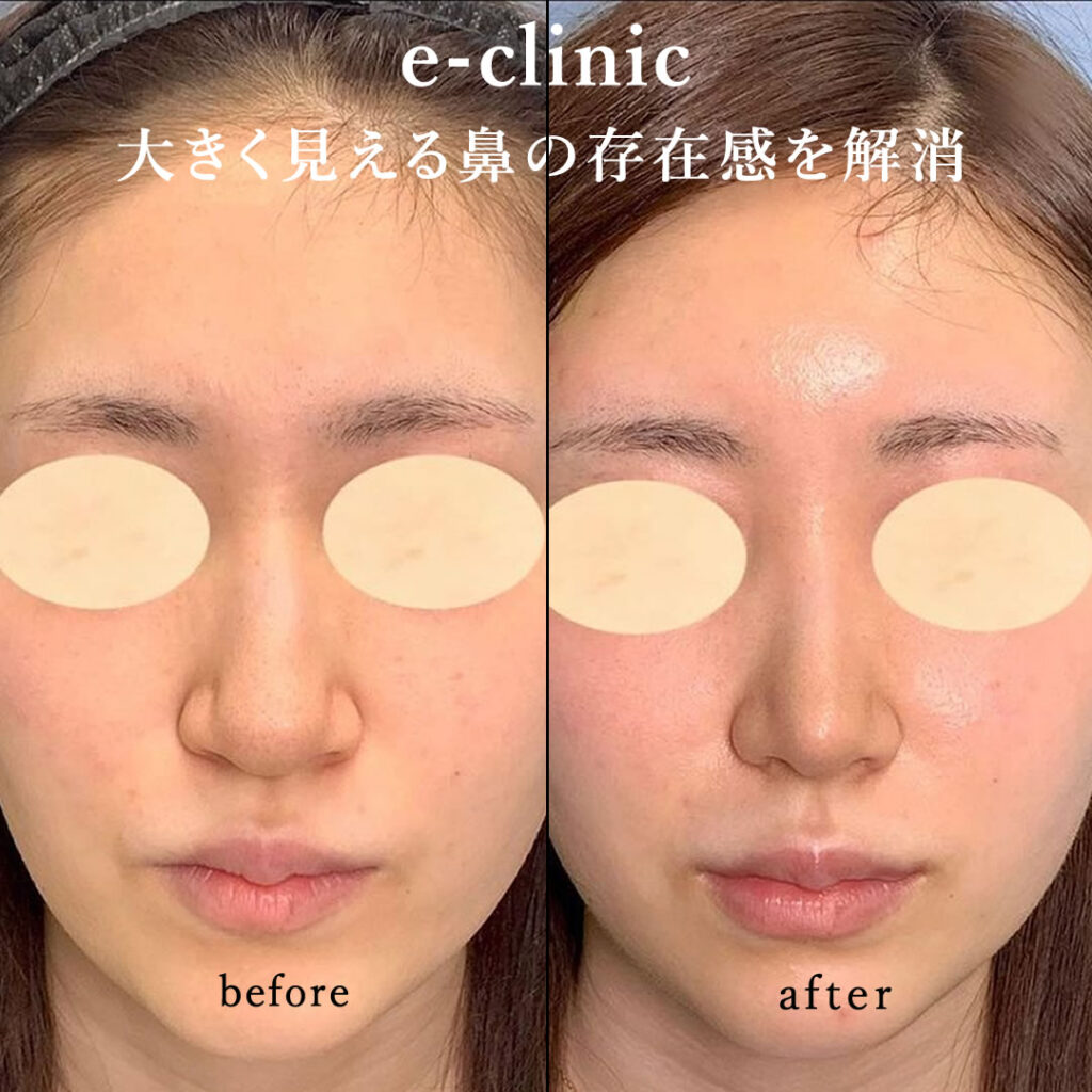 鼻骨骨切りの症例写真