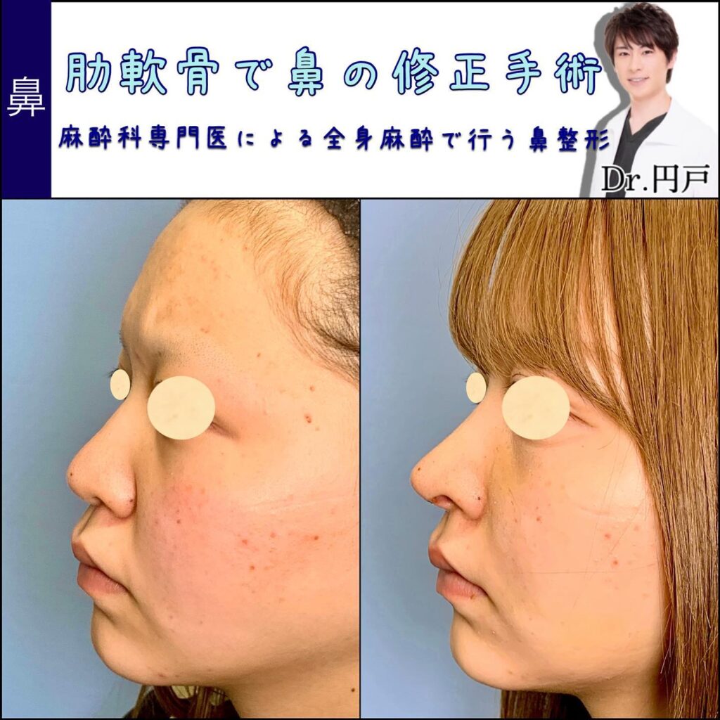 肋軟骨を使用した鼻の修正手術