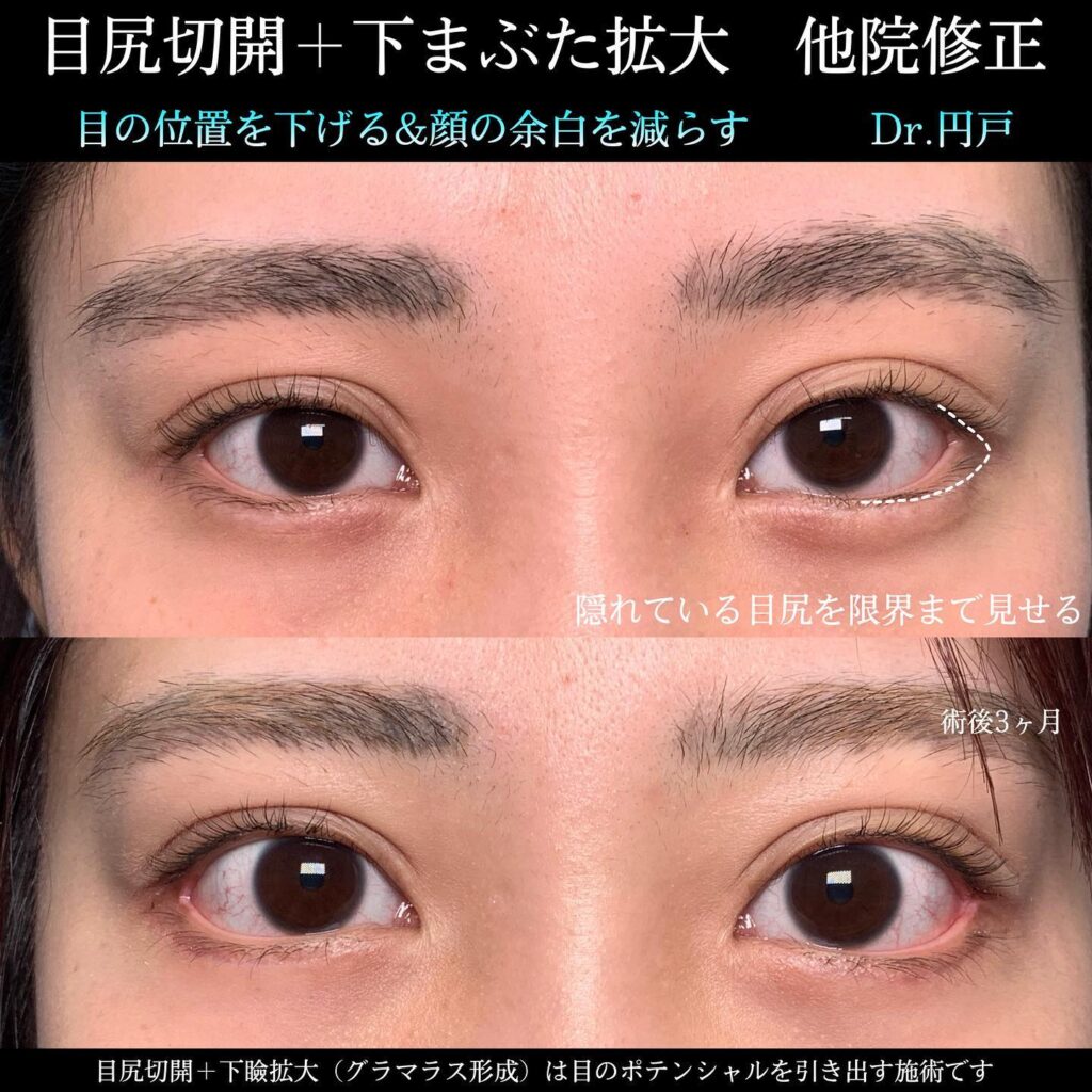 目尻切開とタレ目形成の他院修正