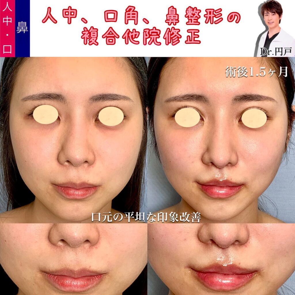 外側人中短縮と口角挙上の他院修正の症例