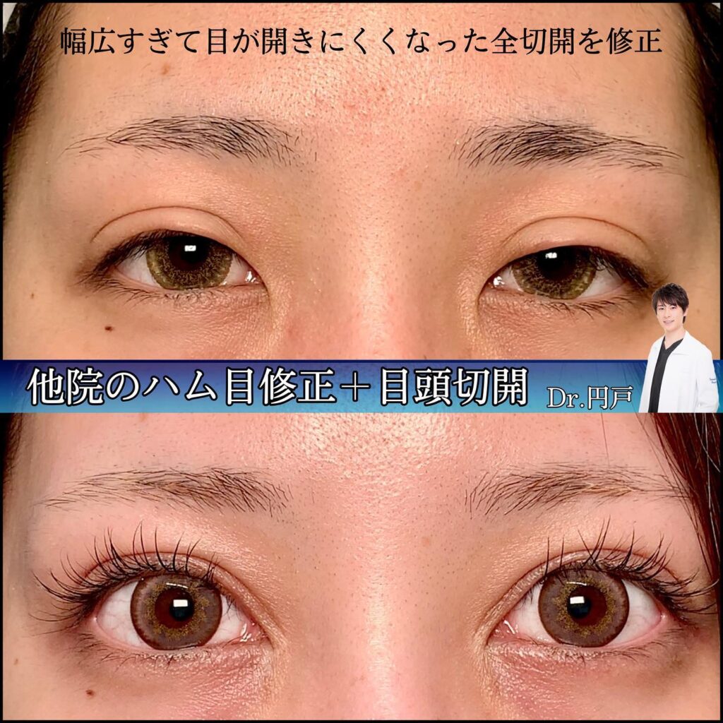 幅が広すぎて目が開きにくくなった全切開の症例