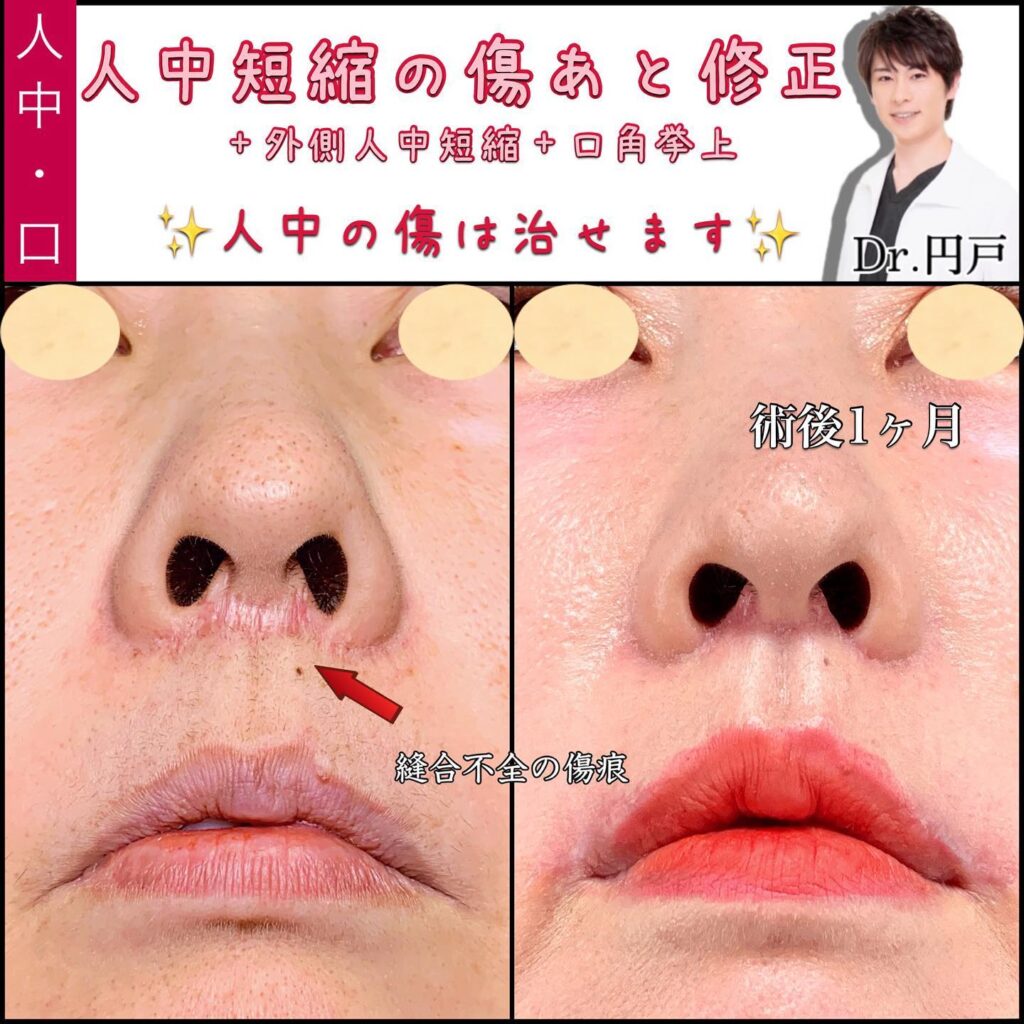 人中短縮の傷跡の他院修正の1か月後の症例
