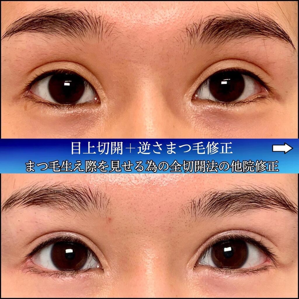 まつ毛を見えるようにした全切開の他院修正の症例