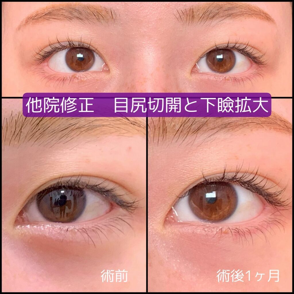 目尻切開とタレ目形成の他院修正の術後1ヶ月後