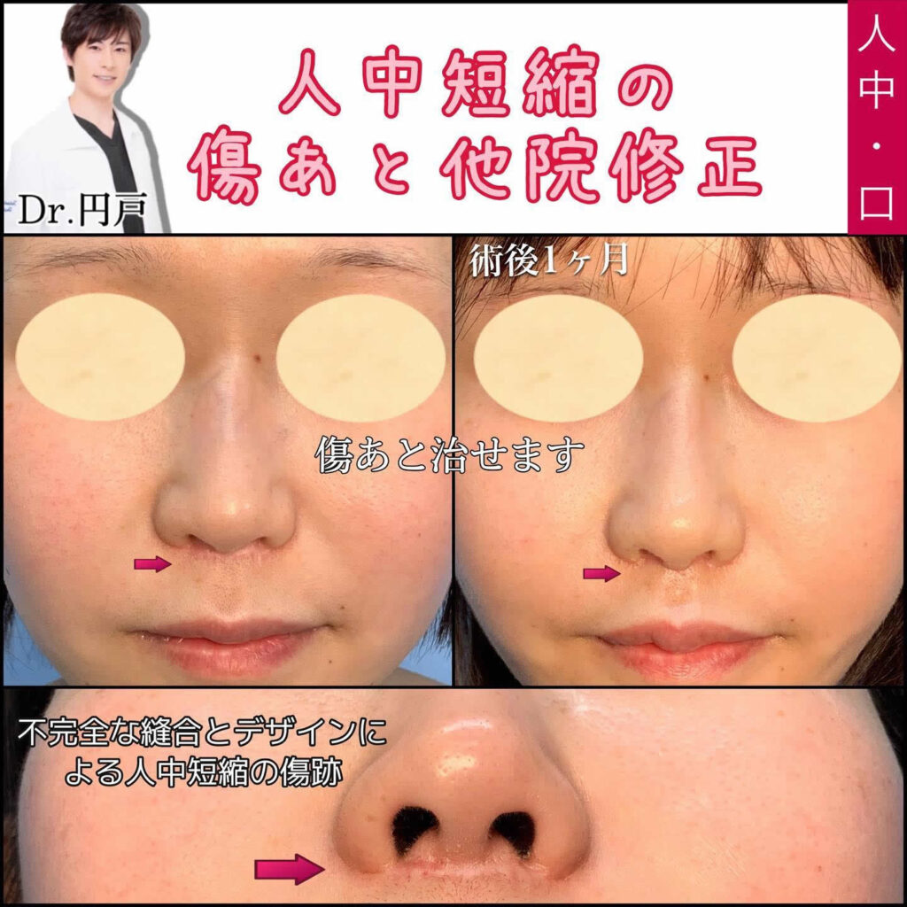 不完全な縫合とデザインによる人中短縮の傷跡の修正の症例