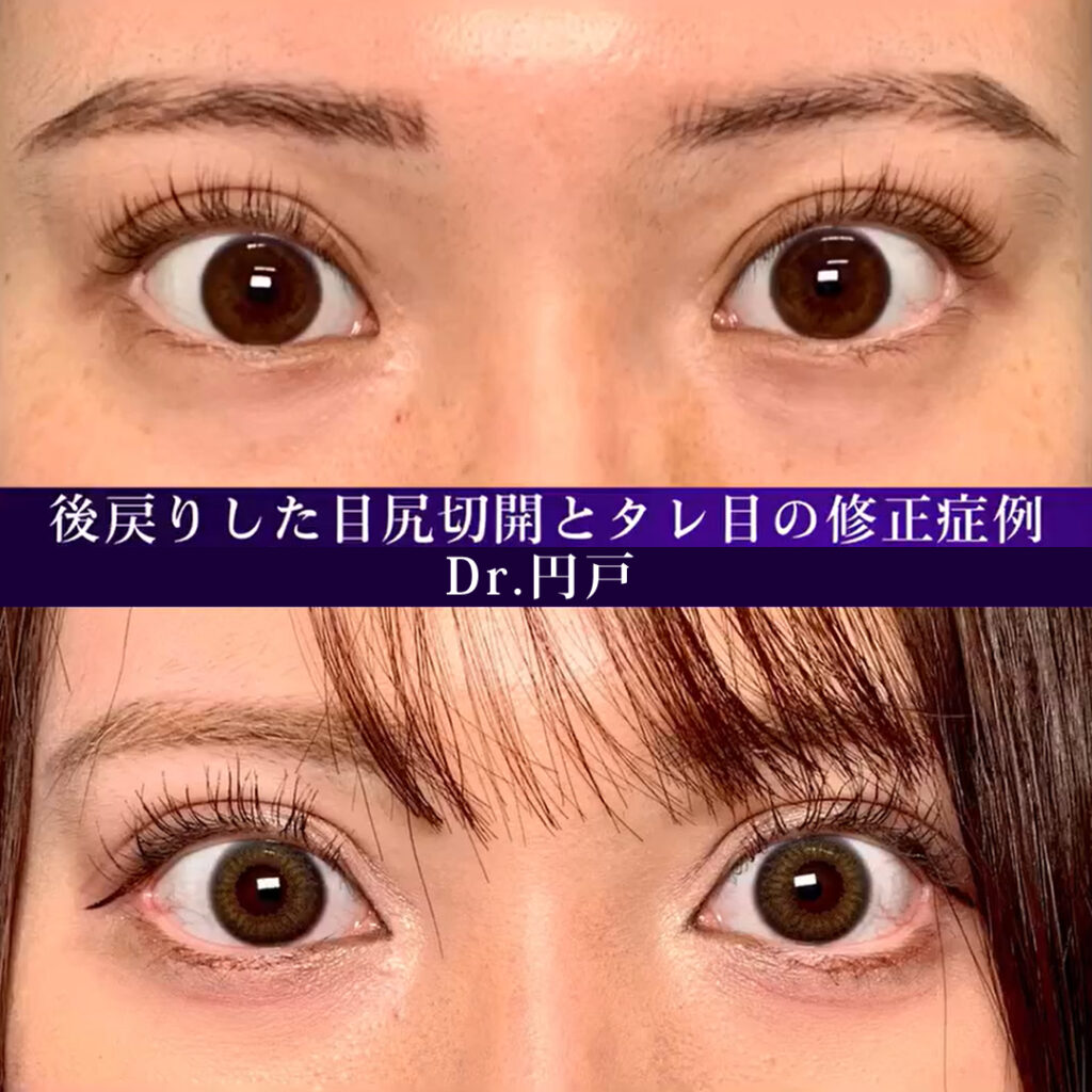 後戻りした目尻切開とタレ目の他院修正の症例写真