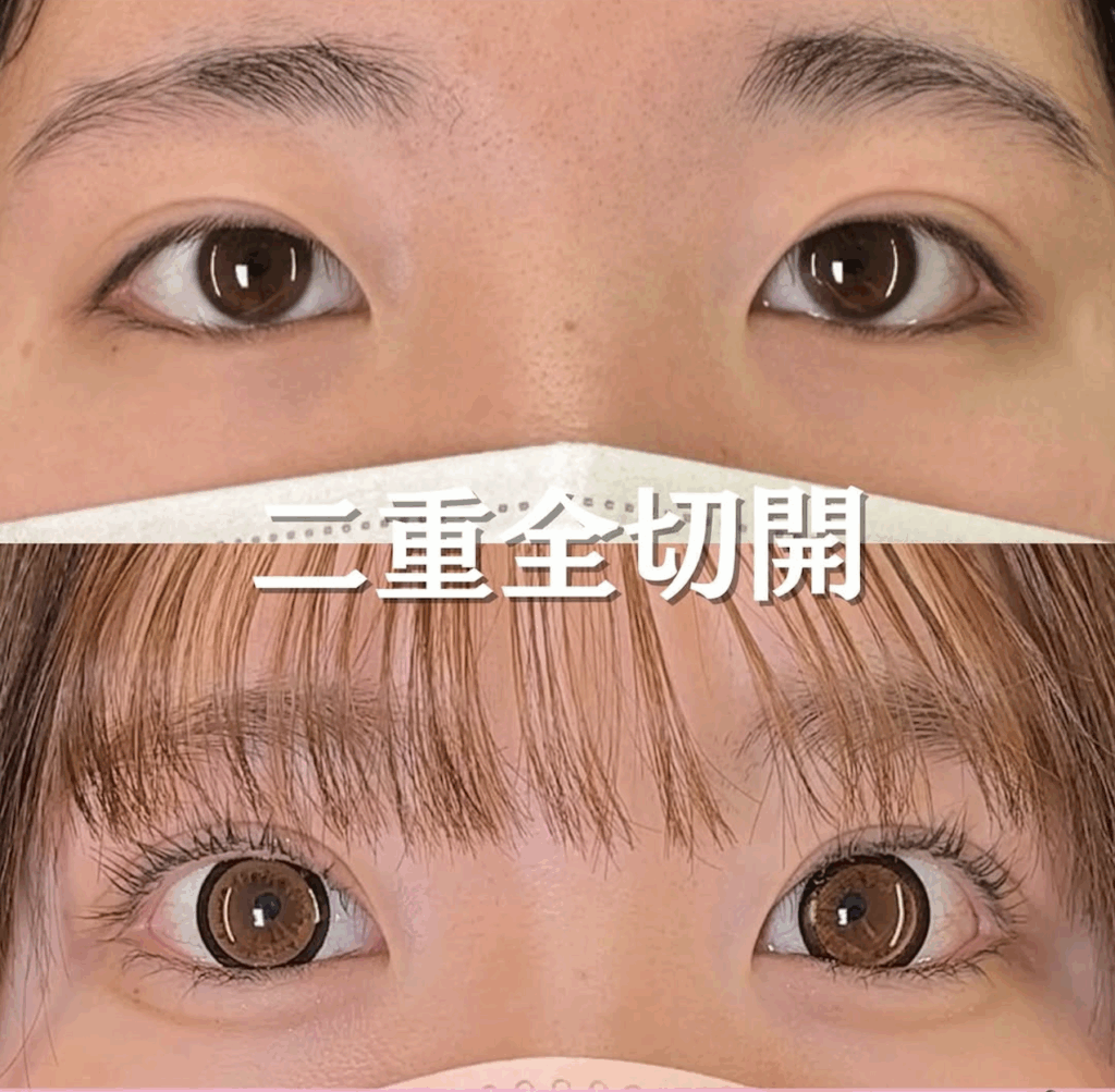 二重全切開の症例写真