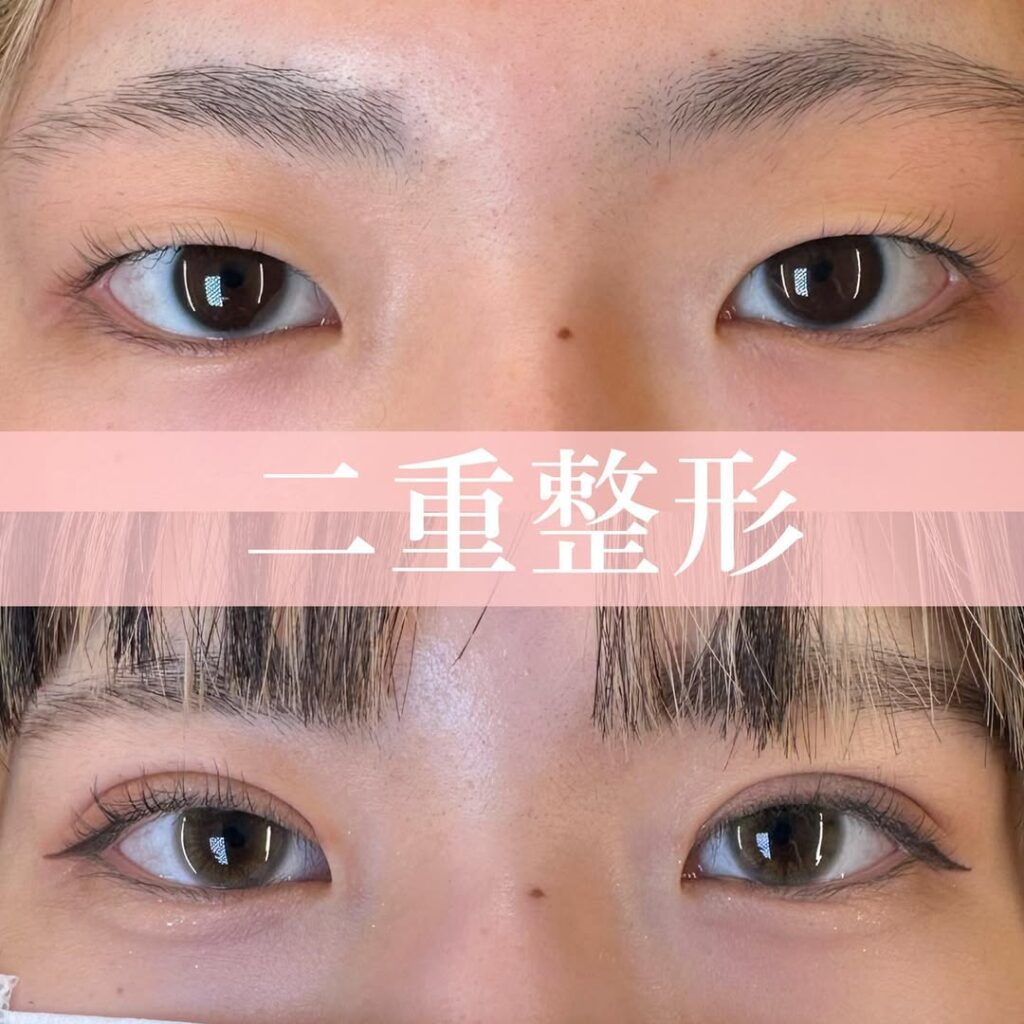 二重埋没法の症例写真