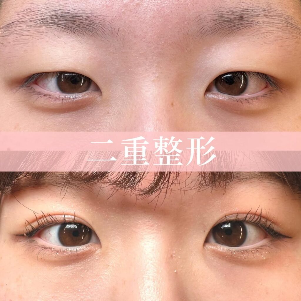二重埋没法の症例写真