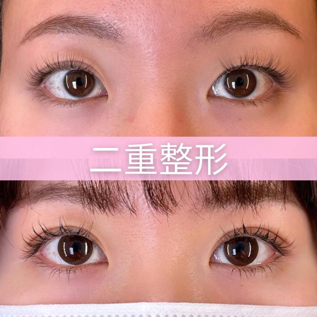 二重埋没法の症例写真