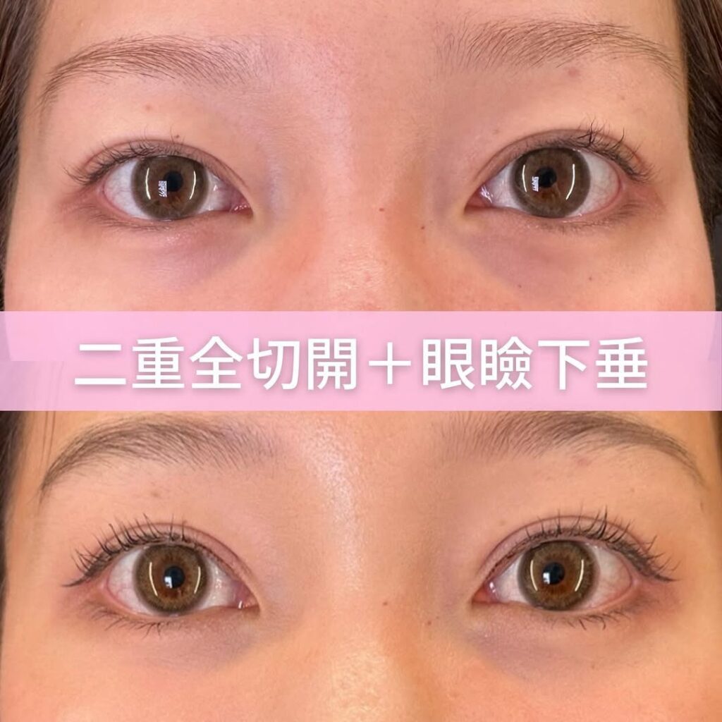二重全切開の症例写真