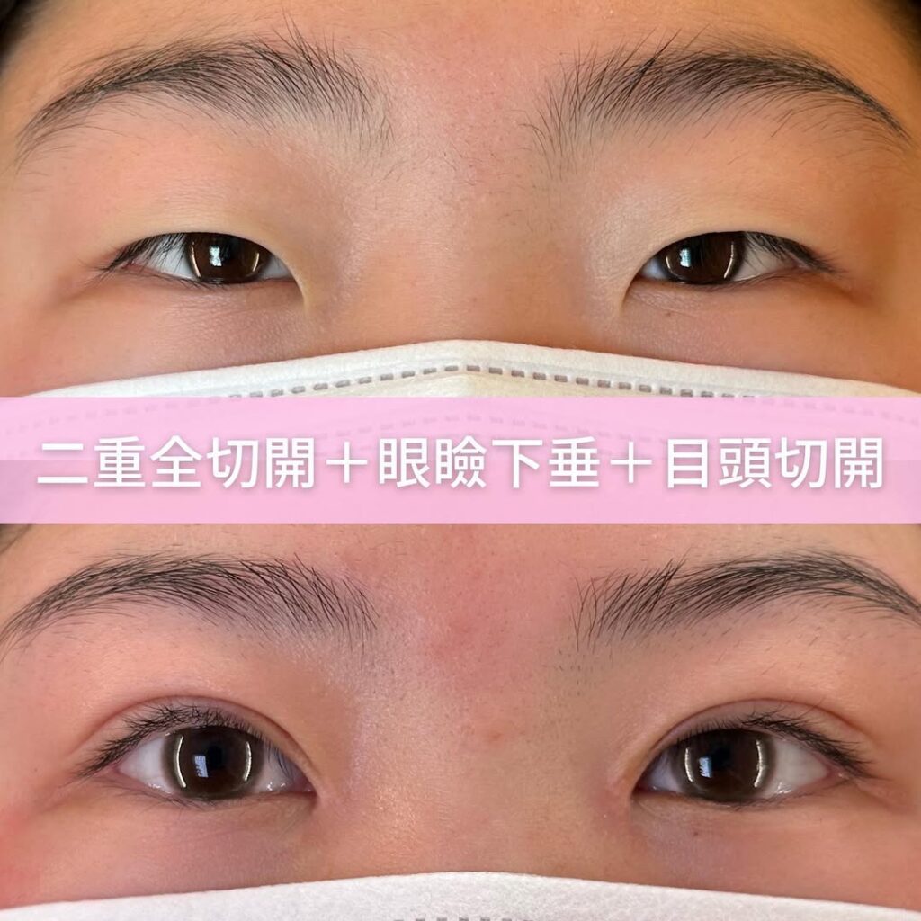 二重全切開+眼瞼下垂+目頭切開の症例写真