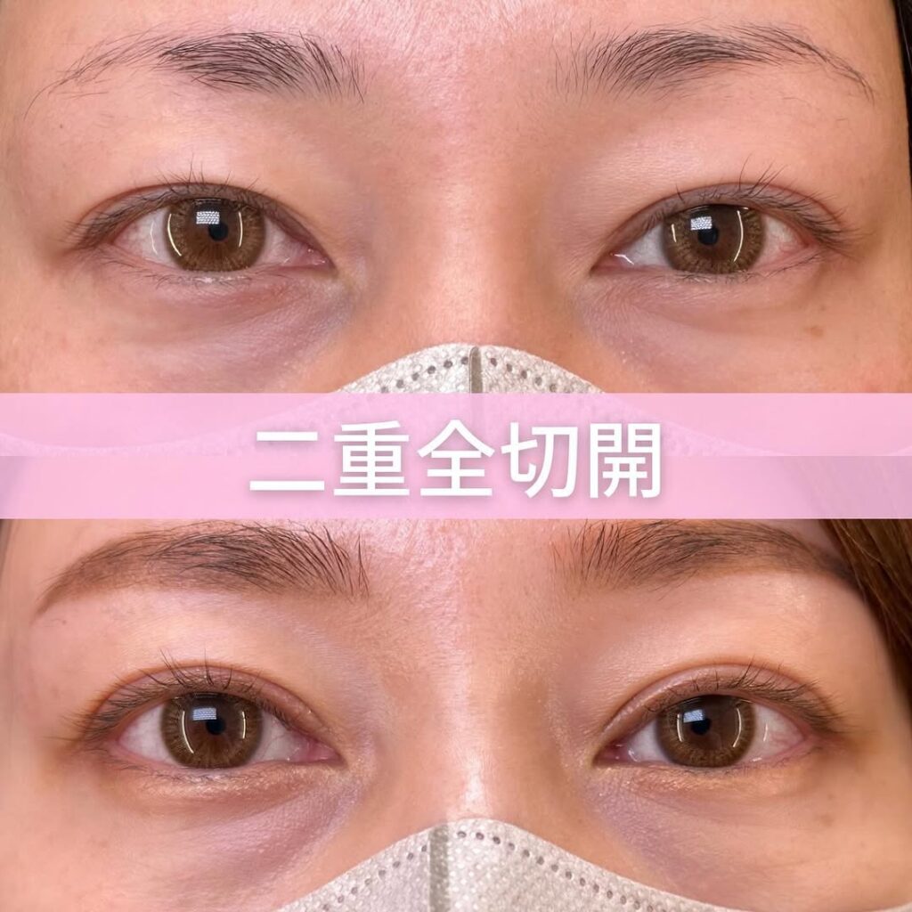 二重全切開の症例写真