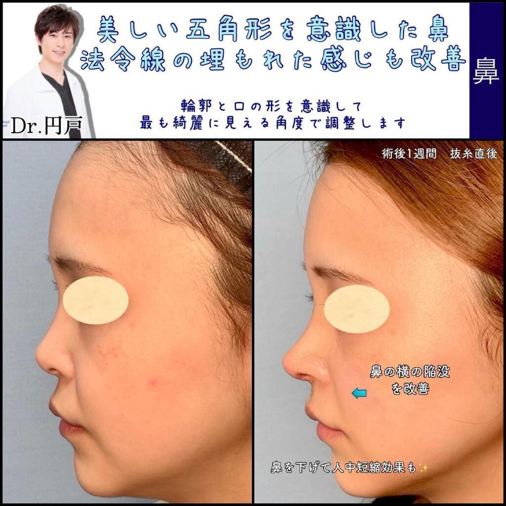 鼻中隔延長、軟骨移植、鼻尖形成の１週間後の症例写真