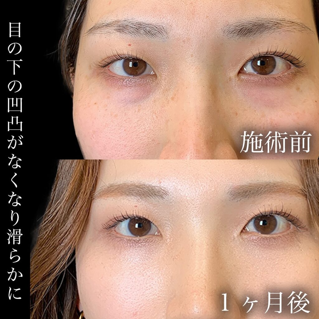 金沢本院の裏ハムラの1ヶ月後の症例写真