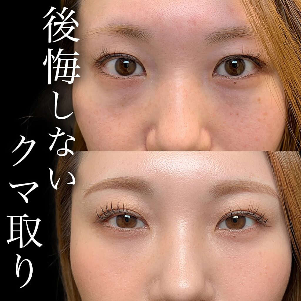 目の下のクマ取りの症例写真 (1)
