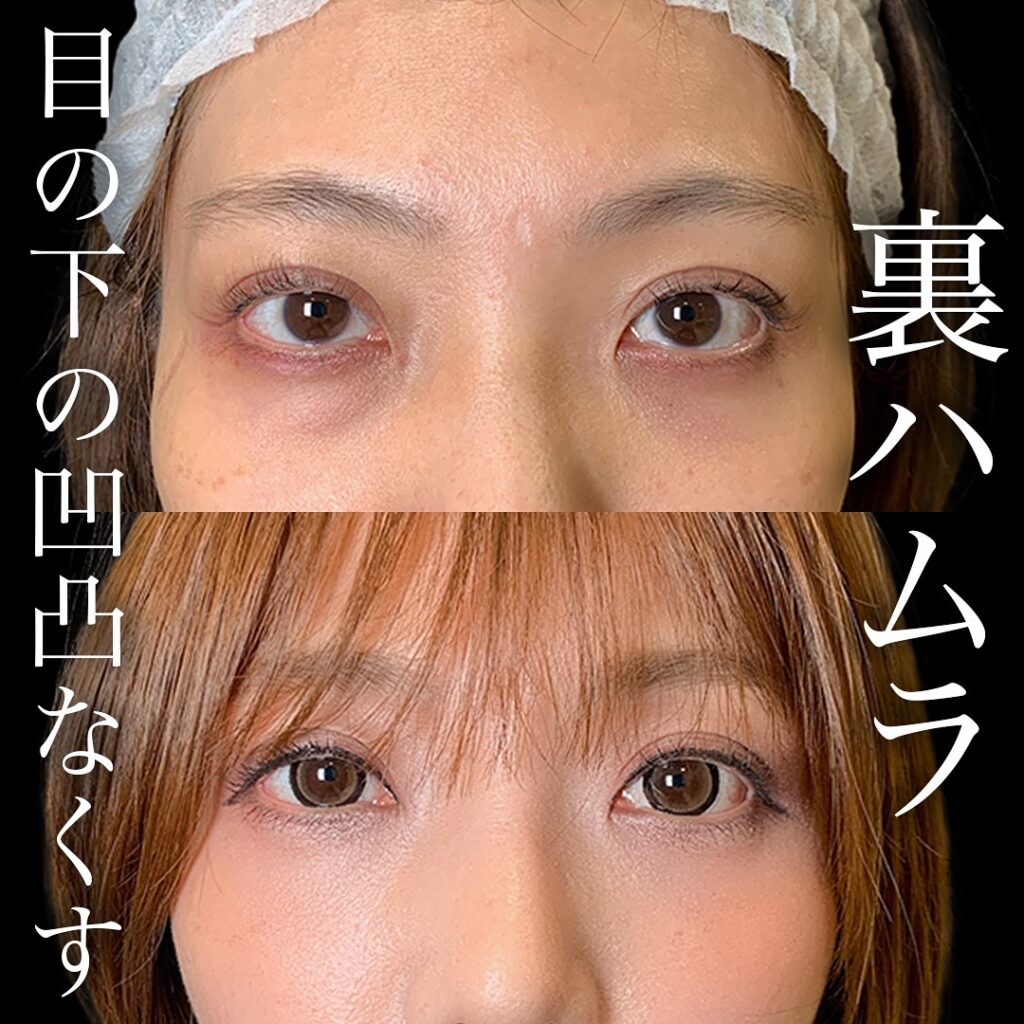 裏ハムラ法の症例写真 (9)