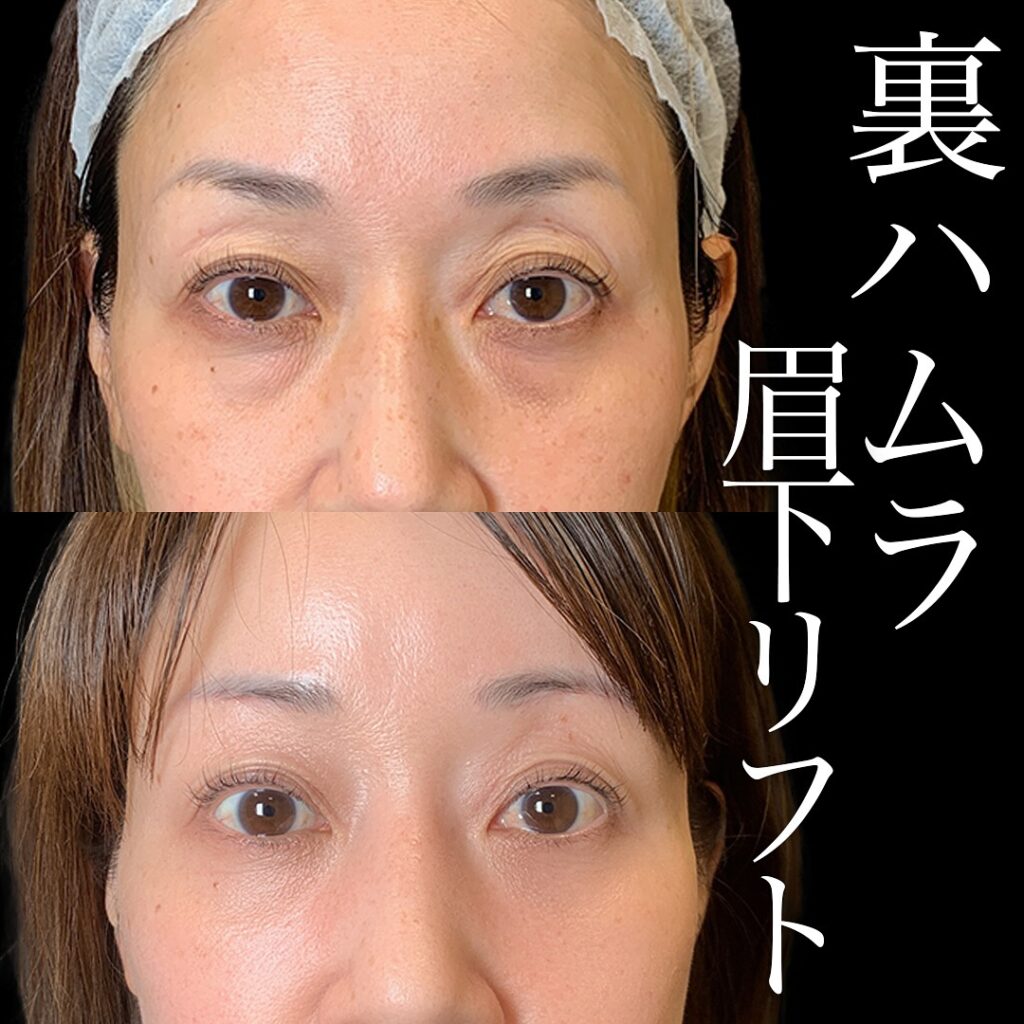 裏ハムラ法と眉下リフトの症例写真