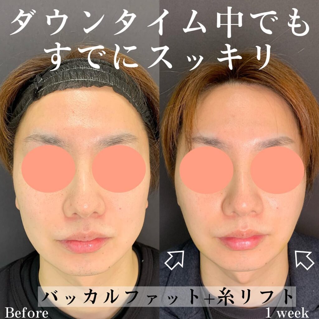 バッカルファットと糸リフトの症例写真