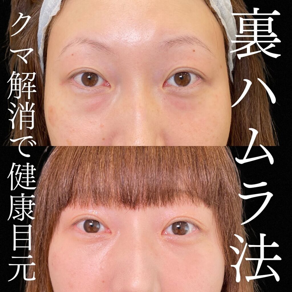 裏ハムラ法の症例写真 (35)