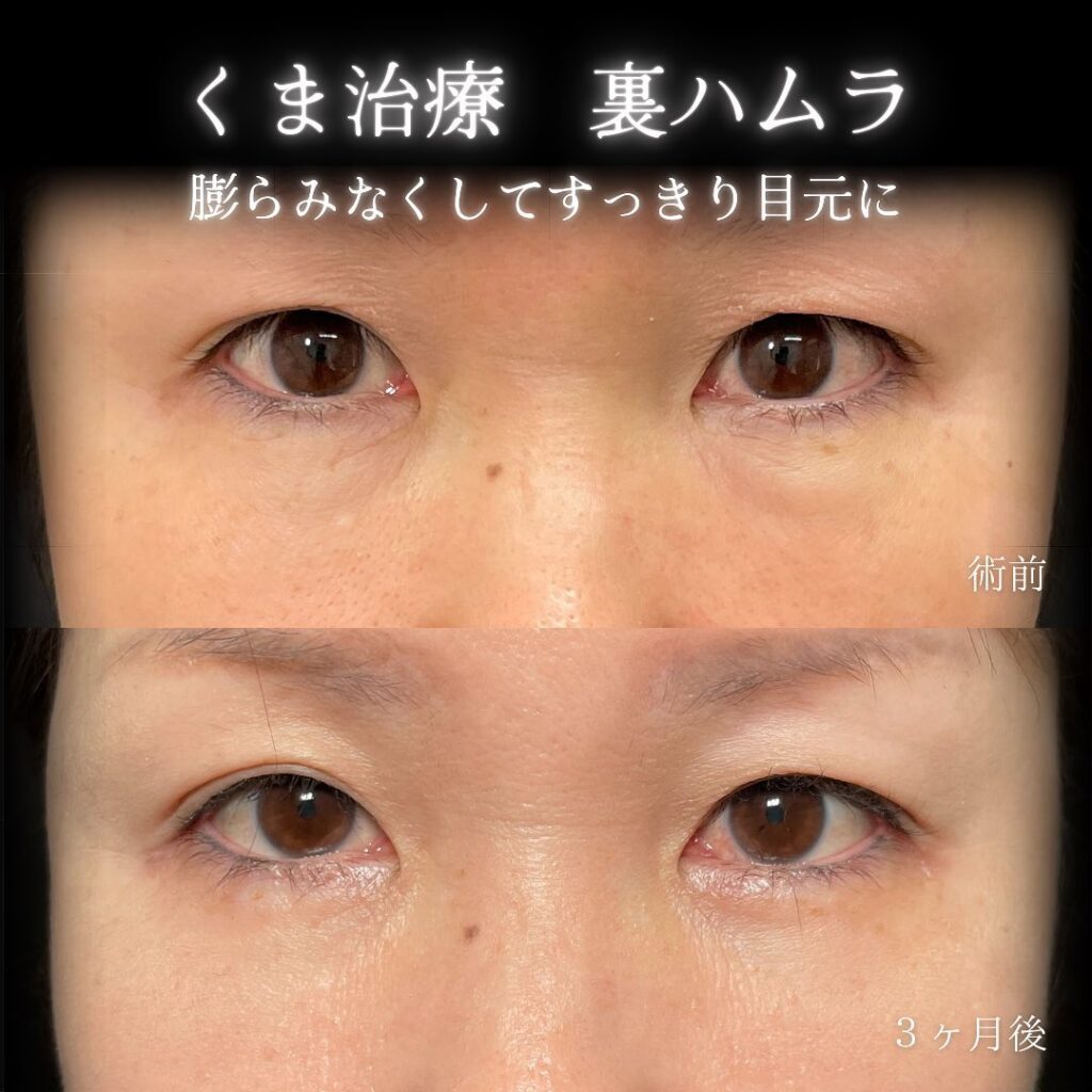裏ハムラ法の症例写真 (30)