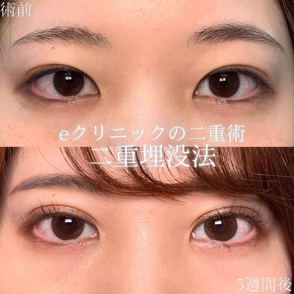 金沢本院の埋没法の症例写真 (5)