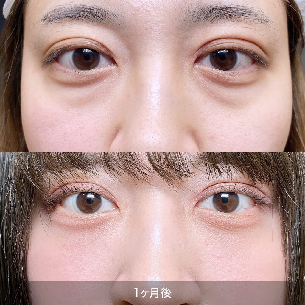 裏ハムラ法の1か月後の症例