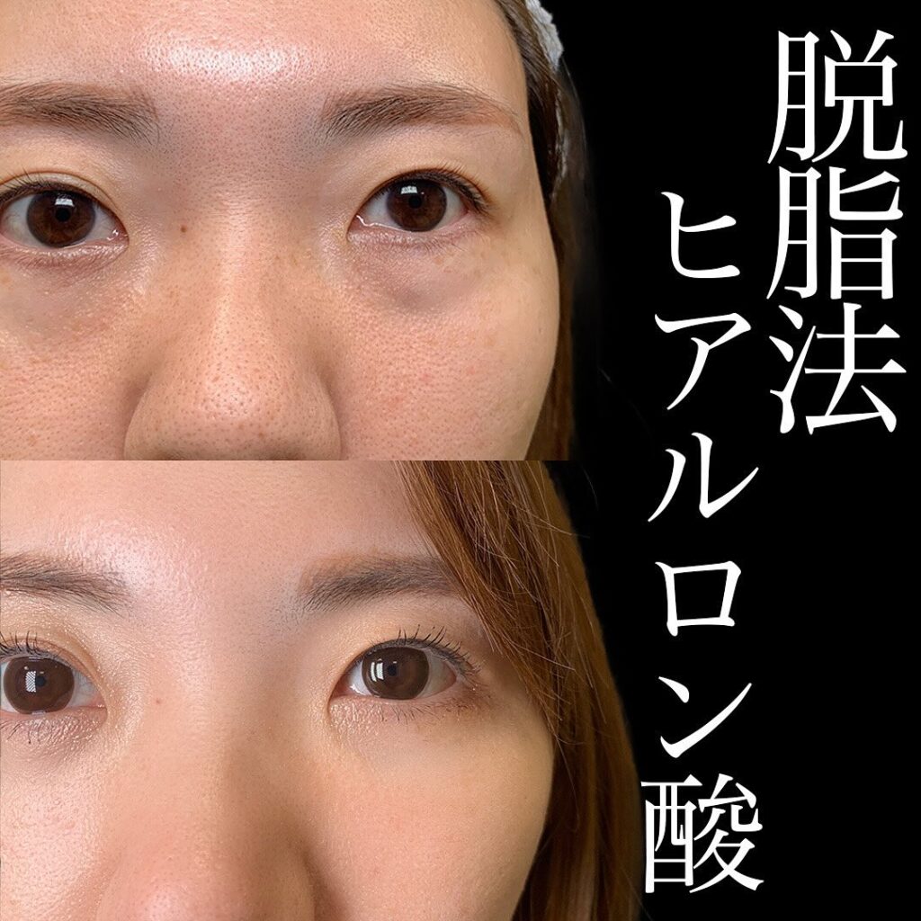 経結膜脱脂+ヒアルロン酸の症例写真