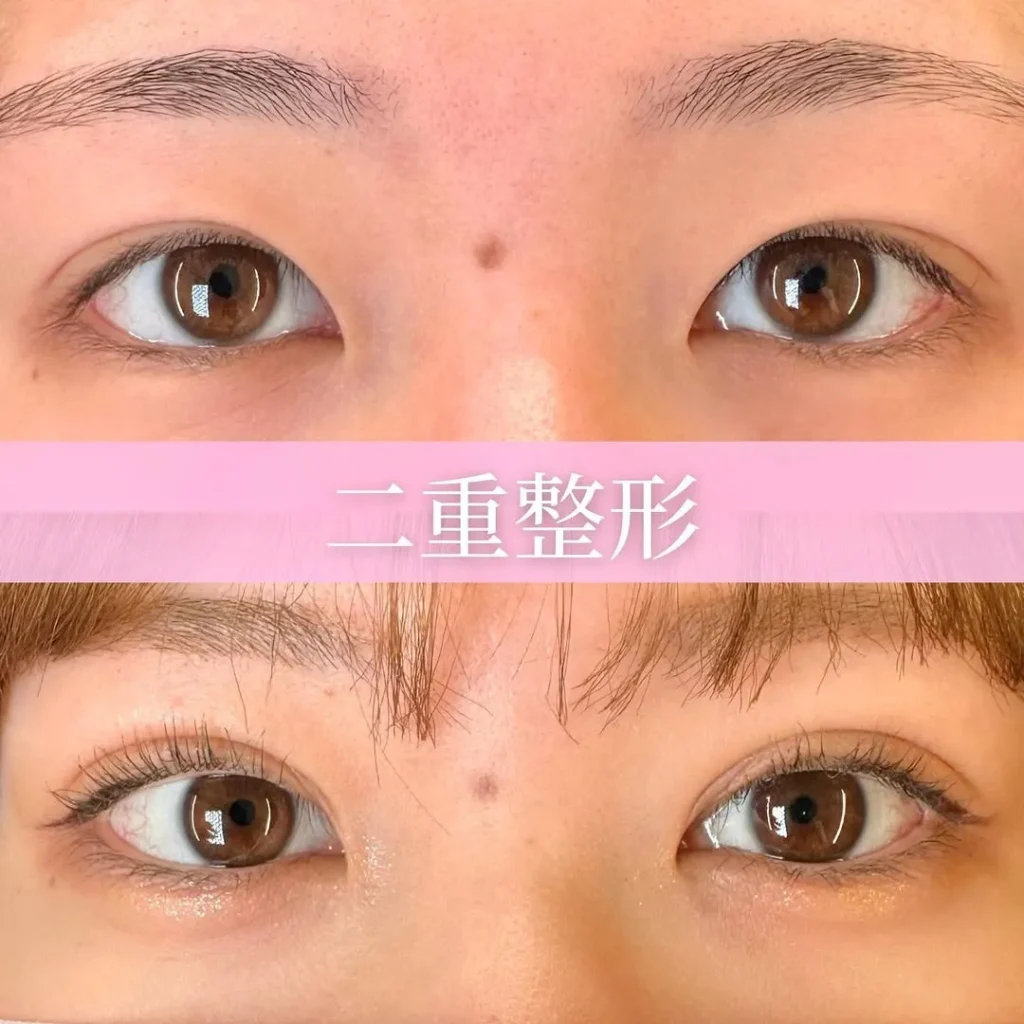 クイックループダブル4点裏留め（島田）