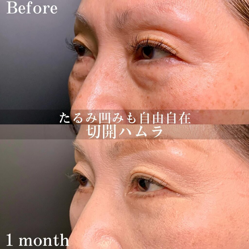 張田医師の切開ハムラ(表ハムラ)の症例写真