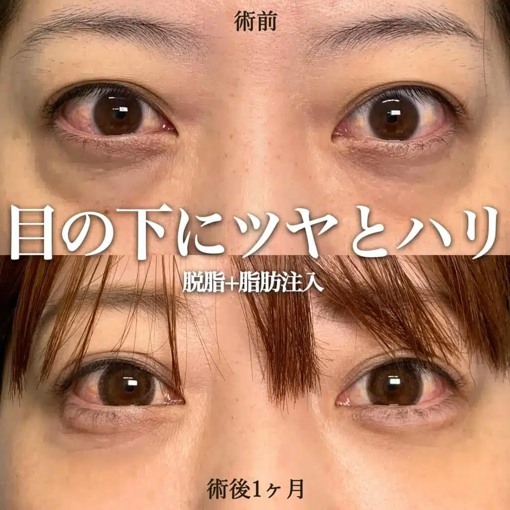 脱脂　脂肪注入