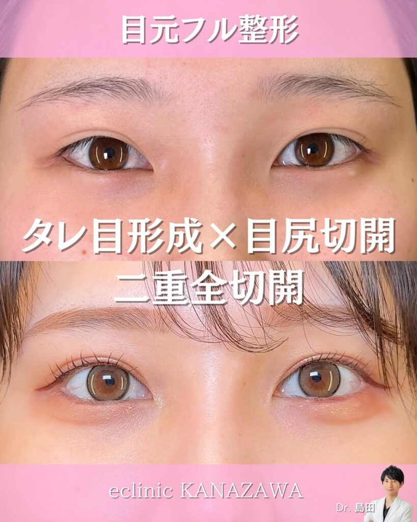 タレ目形成+目尻切開+二重全切開の症例写真