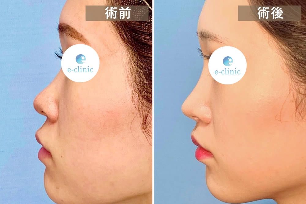 鼻尖形成手術の症例写真